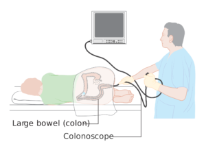 colonoscopy endoscopy 
